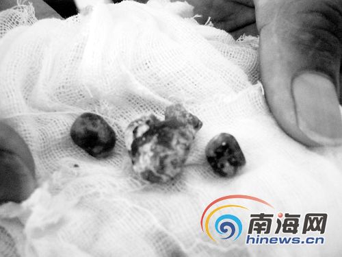 临高8岁男童食三鹿奶粉7年 两肾结石没钱手术