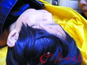 头部发现明显伤痕