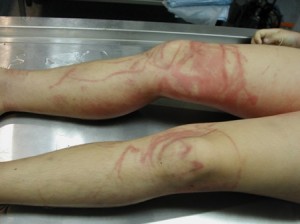 澳10岁女孩成世界首位被最毒生物"箱形水母"蛰伤幸存的人(图)