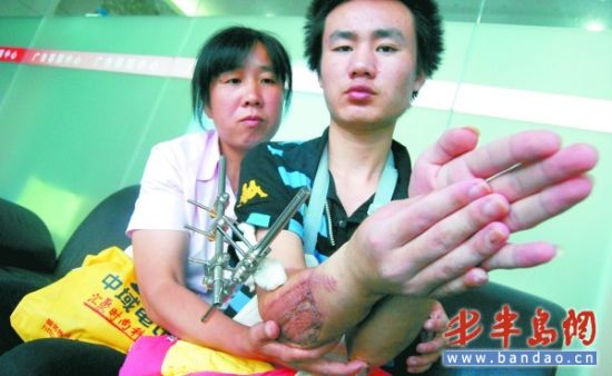 截肢后小渠的右臂明显比左臂短一截.