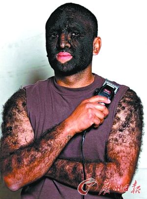 多毛症男如"狼人"称曾交35名女友