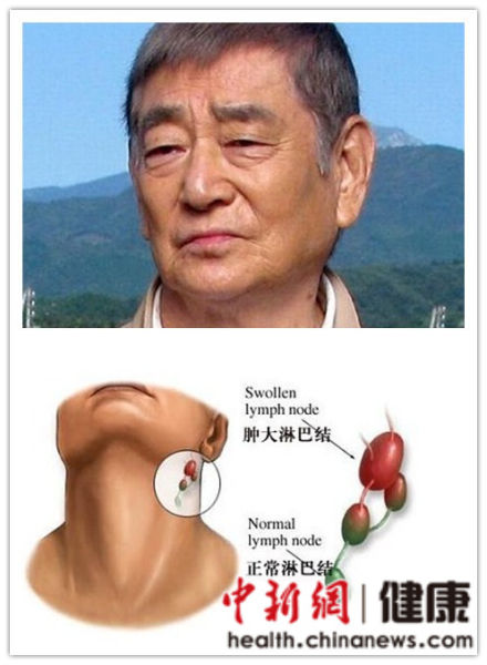 淋巴癌非明星病专家较其他癌症治疗效果好