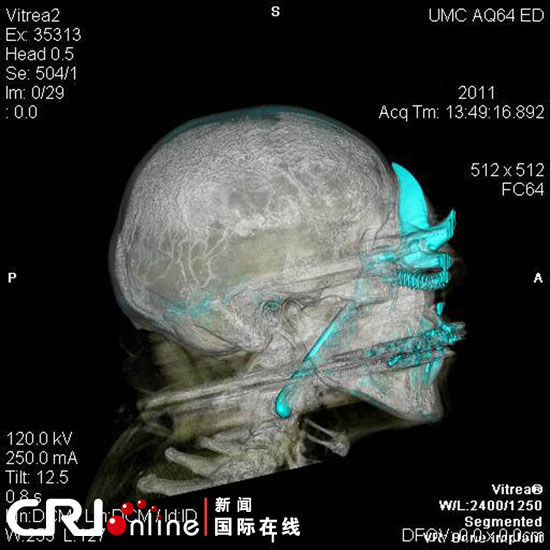 美8旬老人被剪刀从右眼刺入15厘米神奇生还组图