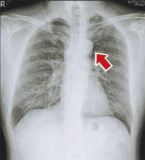 患者x光片有纽扣黑影被医生误诊为肺癌