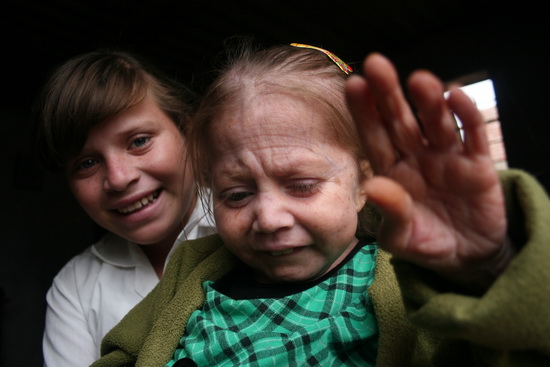 组图8岁女童患早衰症模样似80岁老人