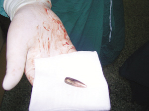 从浦老汉体内取出一颗铮亮的子弹.