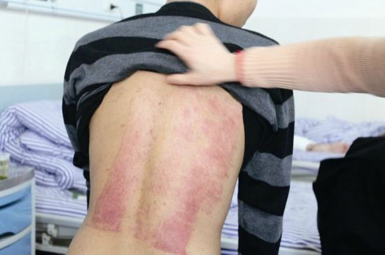 孝子吴辉铭从头部和背部三度割皮给父亲移植