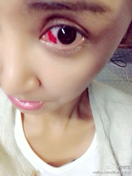 新浪娱乐讯  4月7日21点33分,张歆艺通过微博上传疑似眼底出血的照片