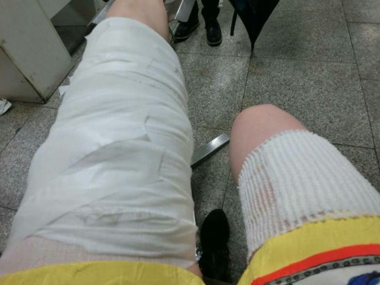上海医院的医护人员为其包扎伤口柳妍熙烫伤入院