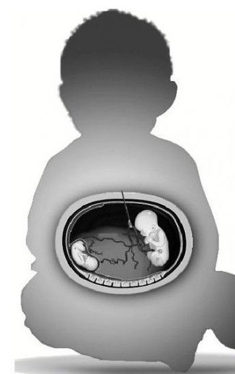 寄生胎有存活的案例吗图片